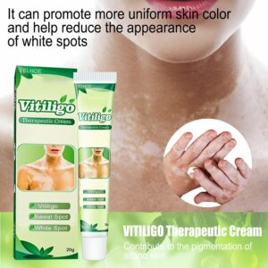 20g White Spot Vitiligotreament Cream Antibacterial Cream Psoriasis Localized Vitiligo Ointment Mycosis Leukoplakia Treatment